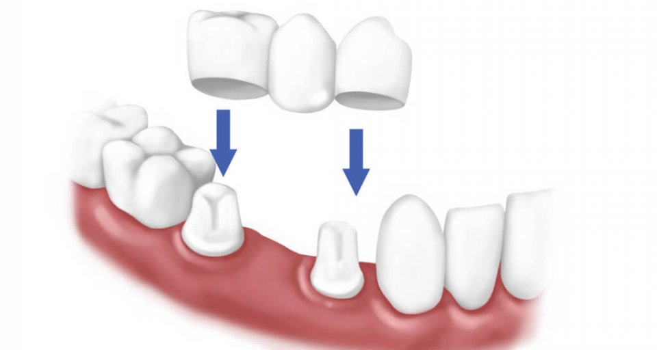 What Exactly Is A Dental Bridge?